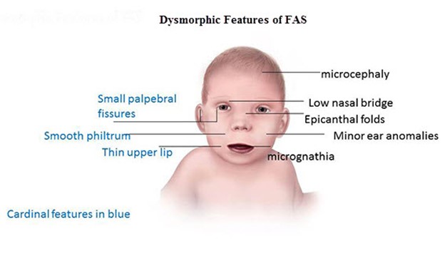 epicanthal fold fetal alcohol syndrome